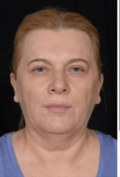 Facial Fat Grafting Before & After Patient #405