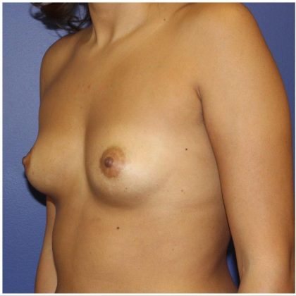 Breast Augmentation Before & After Patient #416