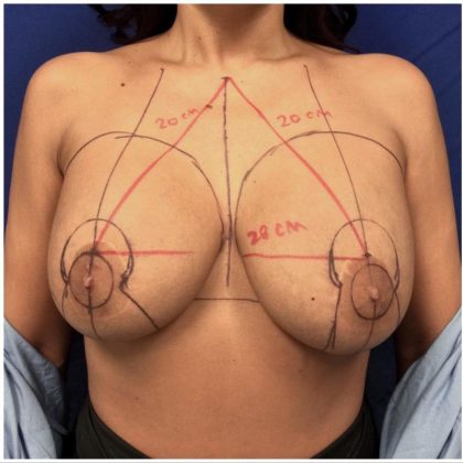 Breast Lift Mastopexy Before & After Patient #417