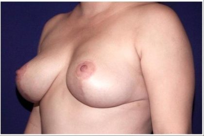 Breast Reduction Before & After Patient #419