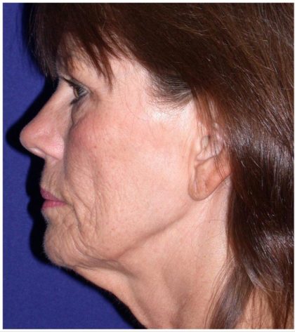 Facelift & Neck Lift Before & After Patient #392