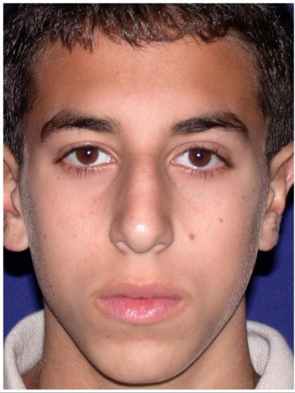 Rhinoplasty Before & After Patient #423