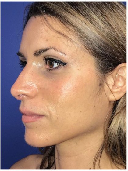 Rhinoplasty Before & After Patient #425