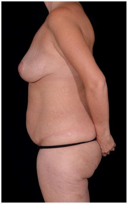 Tummy Tuck Before & After Patient #406