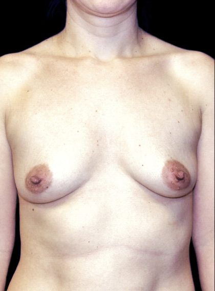 Breast Augmentation Before & After Patient #1616