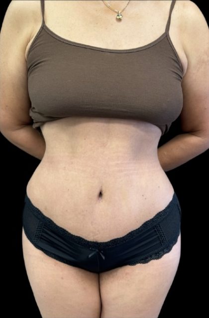 Tummy Tuck Before & After Patient #1566