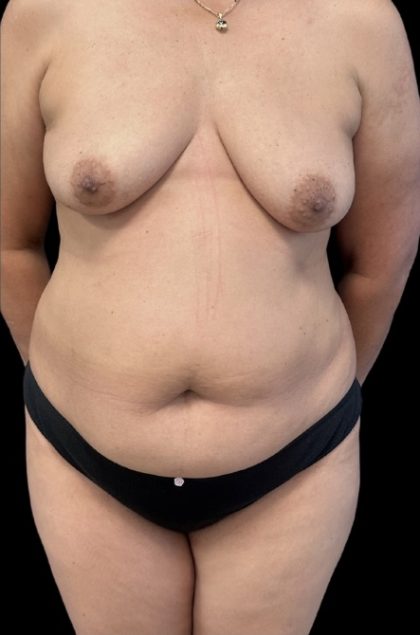 Tummy Tuck Before & After Patient #1566